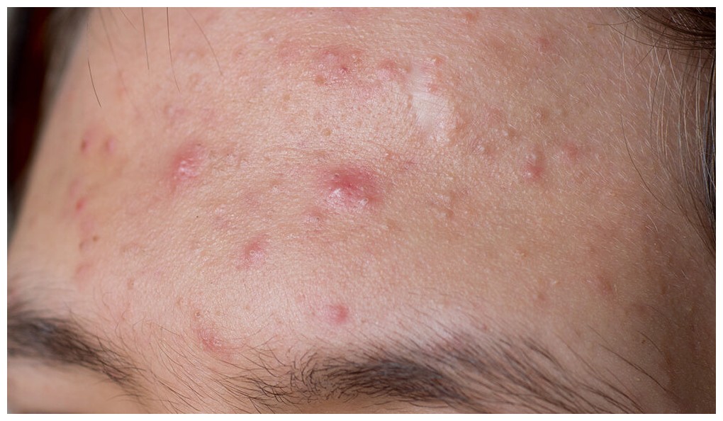 acne vulgaris ringan penyakit kulit yang bisa dirujuk bpjs