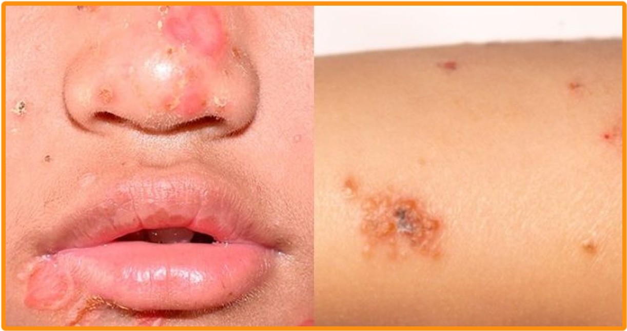 impetigo penyakit kulit yang bisa dirujuk bpjs