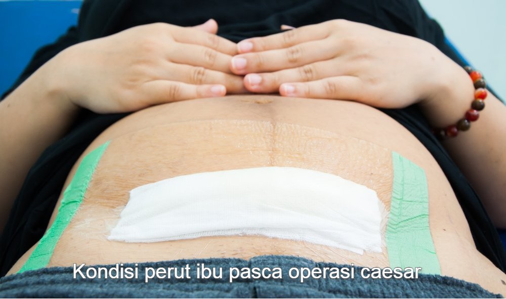 kondisi perut ibu setelah operasi caesar dengan bpjs